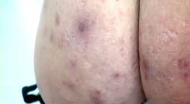 acne-bum.jpg
